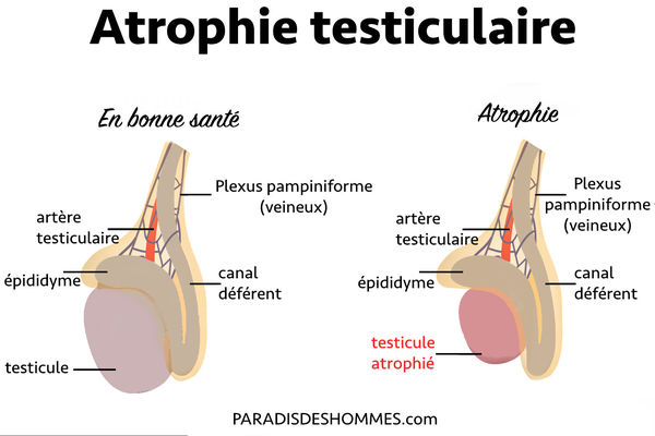 illustration-atrophie-testiculaire