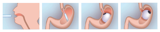 gastric balloon placement
